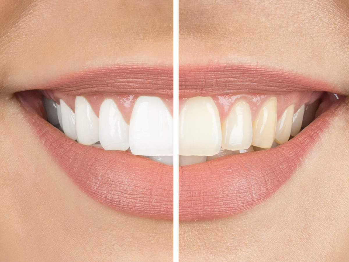 A Few Details About Teeth Whitening