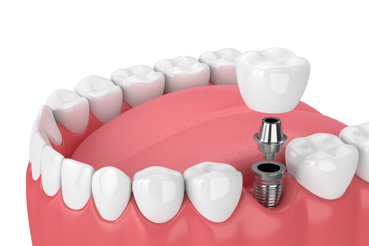 Details On Affordable Dental Implants