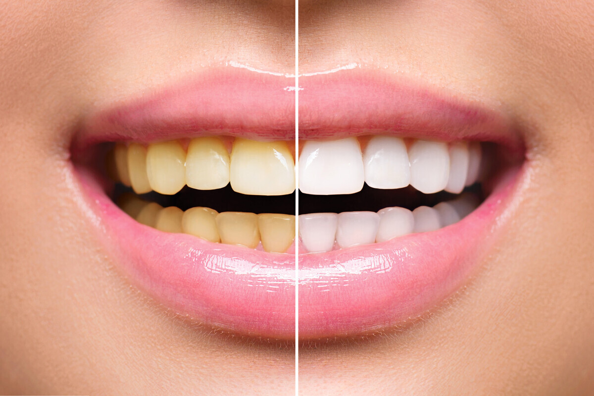 Find What A Pro Has To Say On The Teeth Whitening