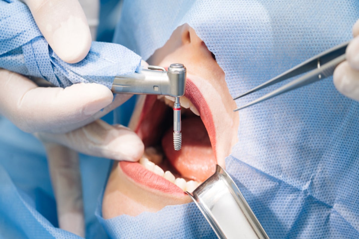 A Little Bit About Dental Implants